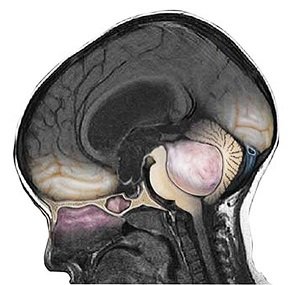 Медуллобластома-головного-мозга